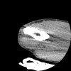 SPORK, NICO - 22.03.1976 - 02.08.2022 - CT obere Extremität - 17:51:17
